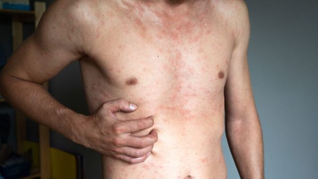 se detecto en el pais el primer caso de viruela del mono sin antecedentes de viaje