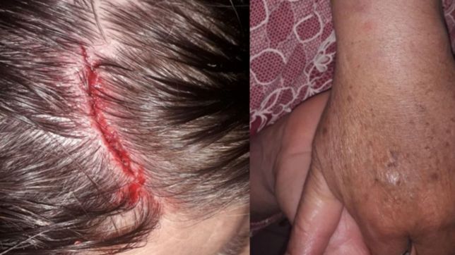 el brutal ataque de dos motochorros a una jubilada en la plata: me abrio la cabeza