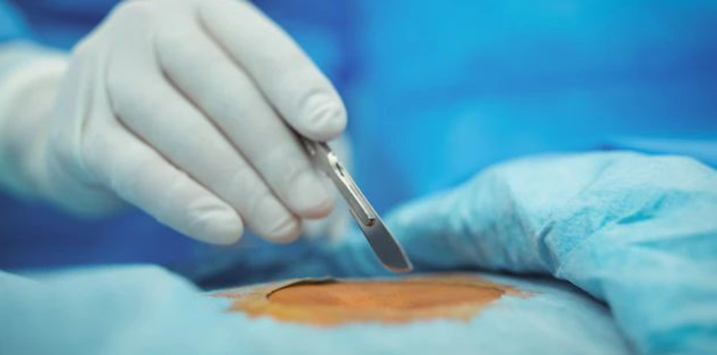 operación - trasplante