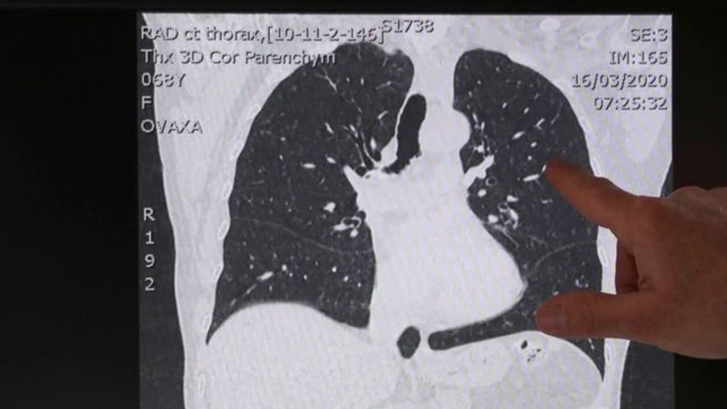 Cuáles son los cuatros tipos de pacientes con coronavirus y qué le pasa a los pulmones