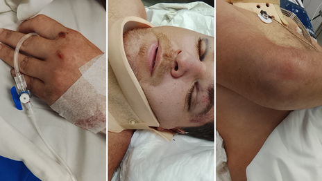 Internaron en grave estado al hombre robado por motochorros en La Plata: Tiene sangrado cerebral Internaron en grave estado al hombre robado por motochorros en La Plata: Tiene sangrado cerebral