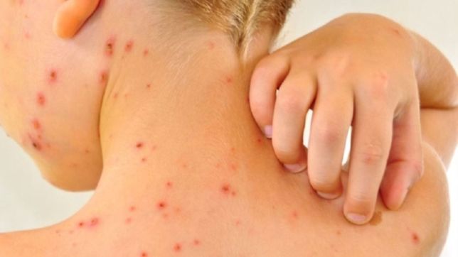 salud emitio un alerta por el riesgo de un brote de sarampion en argentina