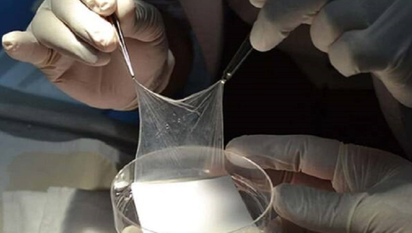 El CONICET logró cicatrizar una compleja úlcera con un parche de placenta humana y evitan una cirugía El CONICET logró cicatrizar una compleja úlcera con un parche de placenta humana y evitan una cirugía