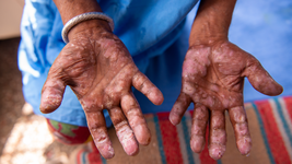 cientificos de la unlp participaron de un impactante descubrimiento sobre el origen de la lepra cientificos de la unlp participaron de un impactante descubrimiento sobre el origen de la lepra