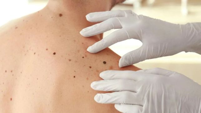 avance contra el cancer de piel gracias a una investigacion del conicet la plata