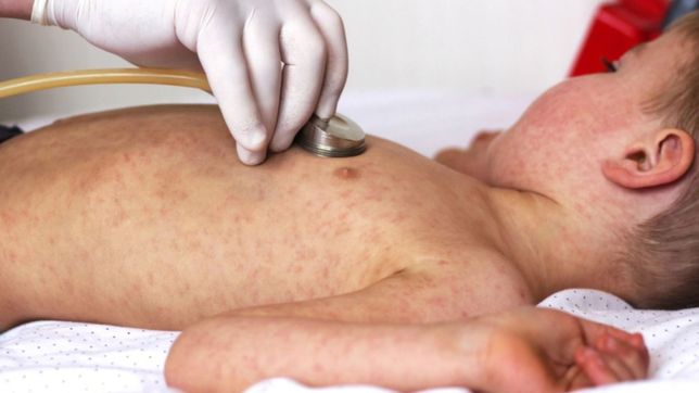 investigan un posible caso de sarampion en ensenada