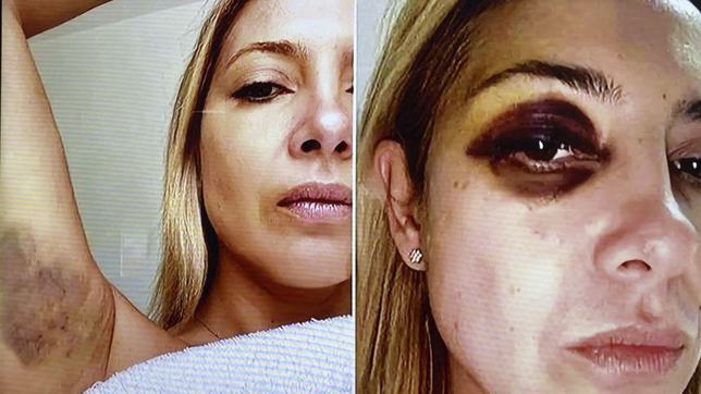 filtran fotos de fabiola yanez con golpes tras la denuncia por violencia de genero