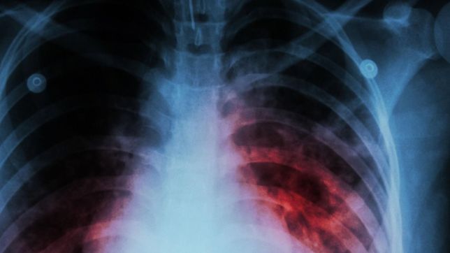 alarma en la plata por el contagio de una estudiante secundaria con tuberculosis