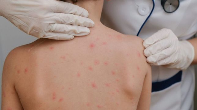 confirman el primer caso infantil de viruela del mono y la primera terapia intensiva