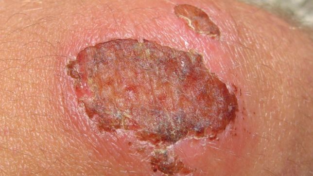 el novedoso metodo de la unlp para regeneracion de la piel lesionada sin dolor