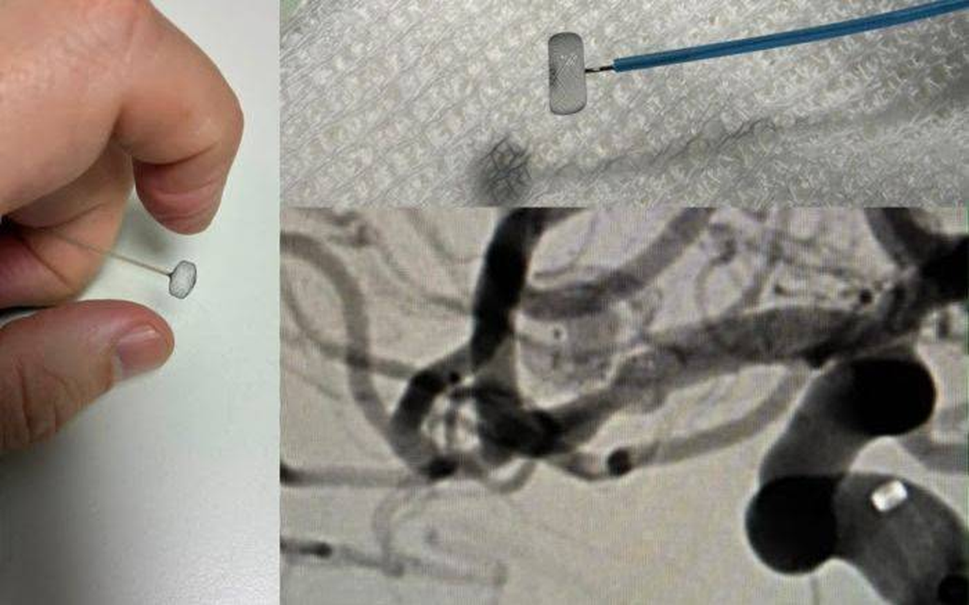El dispositivo Woven EndoBridge (WEB) utilizado por el Hospital San Mart&iacute;n para tratar aneurismas cerebrales
