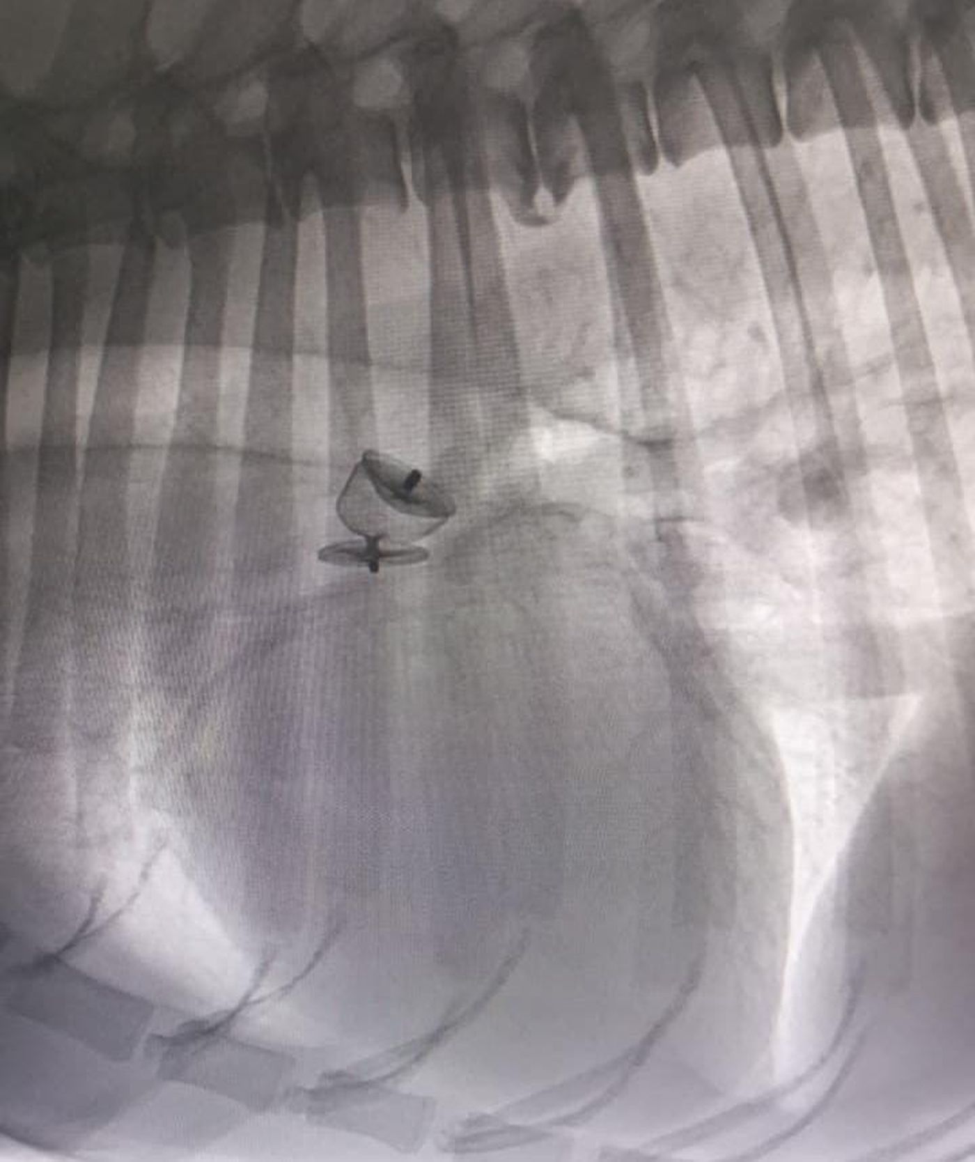 El dispositivo Amplatzer se utilizó para cerrar el conducto arterioso persistente mediante una técnica endovascular