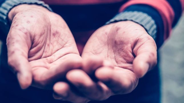 ¿como se contagia y cuales son los sintomas de la viruela del mono para detectarla?
