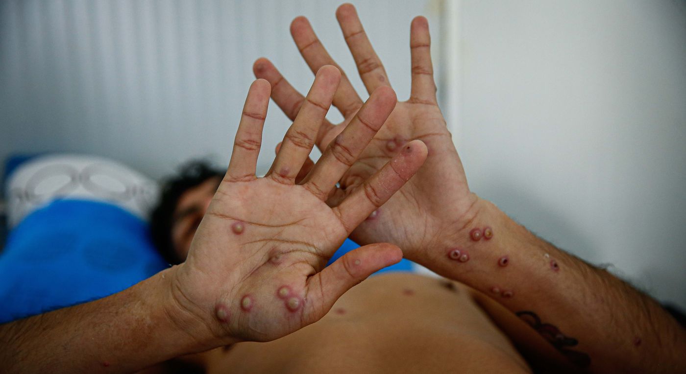 Viruela del mono.jpg