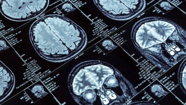 alzheimer: las tres senales de alerta metabolica a los 35 anos
