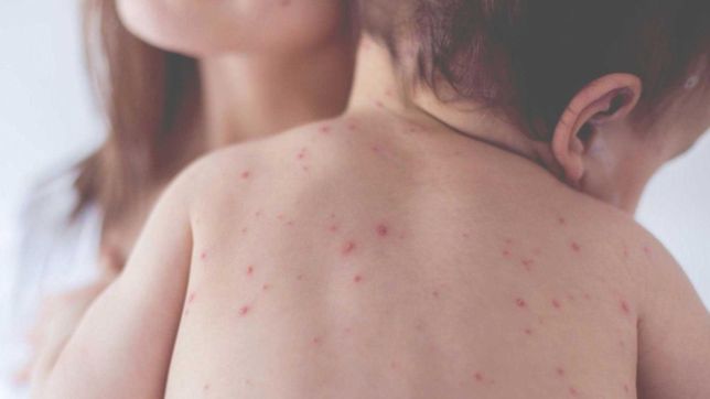 el ministerio de salud bonaerense pide completar la vacunacion contra el sarampion