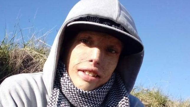 fue victima de un tragico incendio y hoy lucha para volver a trabajar