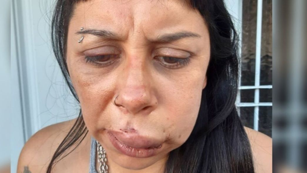 Violencia de género: el crudo relato de la mujer que fue atacada brutalmente por su pareja