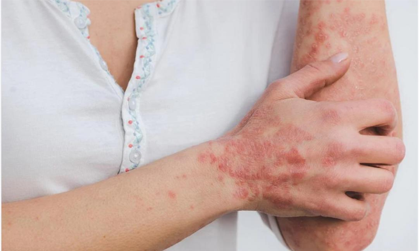 Viruela símica (7).png