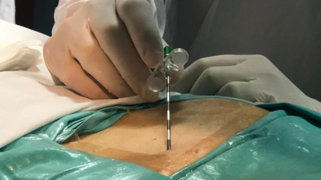 un hospital platense realizo una inedita intervencion para tratar arritmias