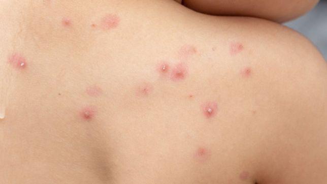 la oms asegura que la viruela del mono es controlable y el riesgo de contagio es bajo