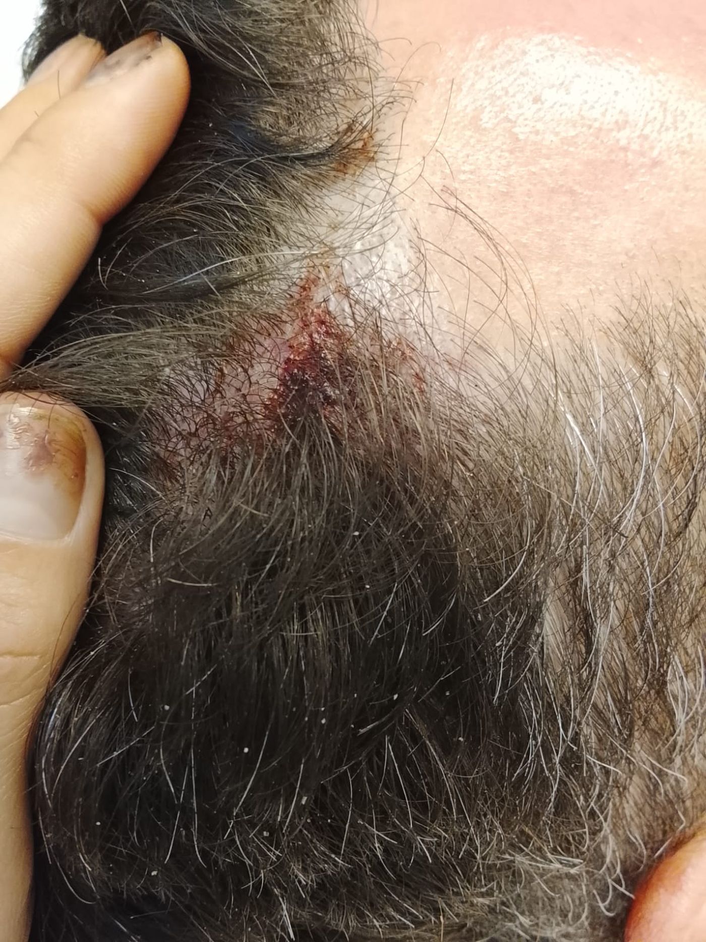 Un golpe que habría recibido en la caída.