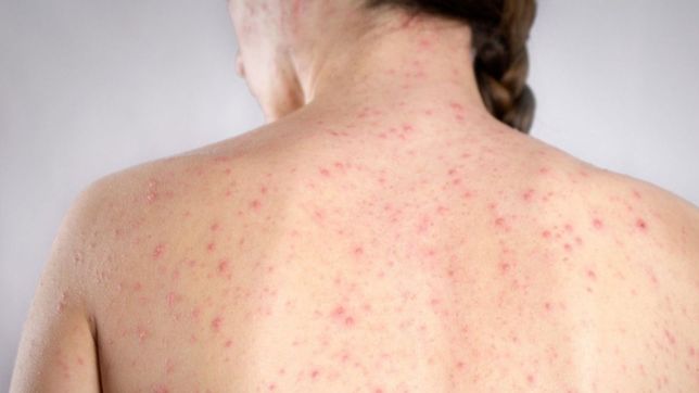 advierten por un posible caso de sarampion en caba y emiten un alerta epidemiologico