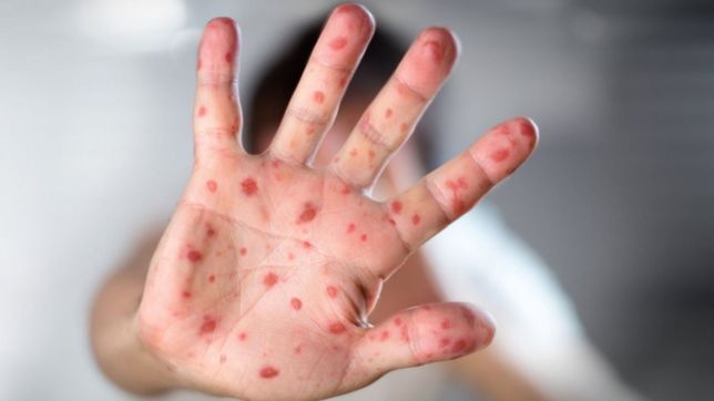 ya son cuatro los casos de sarampion en el pais: hay alerta epidemiologico