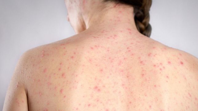 confirmaron un caso de sarampion importado desde medio oriente en caba