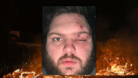 Un joven resultó herido en la quema de un muñeco de La Plata y perdió parte de la visión de un ojo Un joven resultó herido en la quema de un muñeco de La Plata y perdió parte de la visión de un ojo