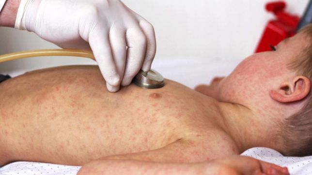 ya hay 20 casos de sarampion en el amba y la provincia activa un nuevo sistema de atencion