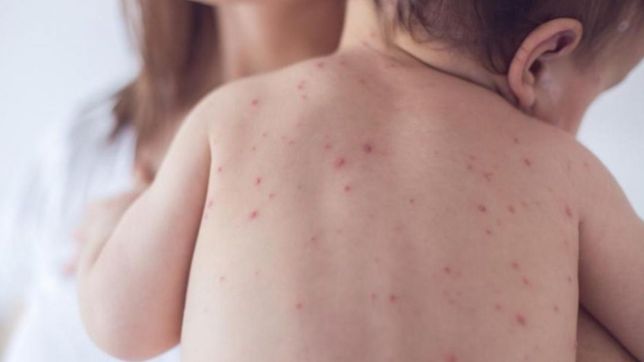 ante los nuevos casos de sarampion, ¿cuales son los sintomas y como se previene?