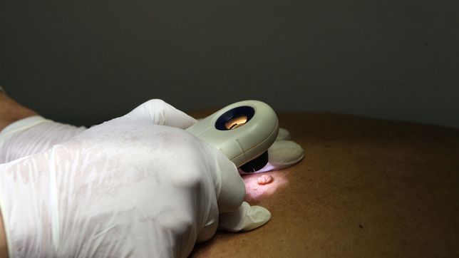 habra controles de lunares en la plata para prevenir el cancer de piel