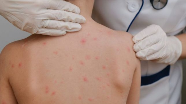 la oms propone cambiar el nombre de la viruela del mono para no estigmatizar a africa