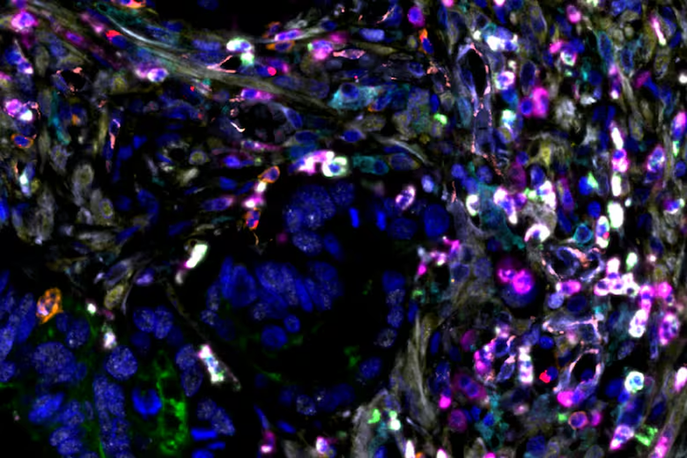 Tejido tumoral de cáncer de colon. Se puede observar una expresión elevada de GAL-1, acompañada de una acumulación de MDSCs y baja presencia de linfocitos
