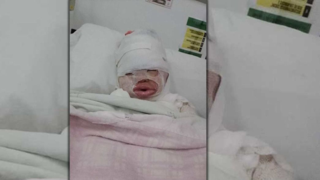 ¿Cómo sigue la nena que se quemó con aceite hirviendo y está internada en La Plata?
