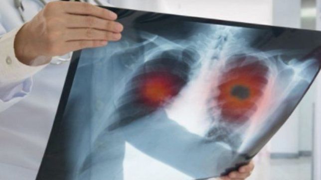 revelan que los pulmones de quien tuvo covid-19 quedan peor que los de los fumadores