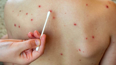 Finalizó el brote de sarampión en la provincia de Buenos Aires Finalizó el brote de sarampión en la provincia de Buenos Aires