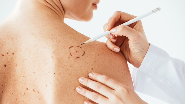 la plata reune a especialistas en cancer de piel para impulsar el diagnostico temprano y reducir la mortalidad