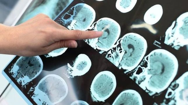 confirman el primer caso de sindrome anal inquieto como consecuencia del coronavirus