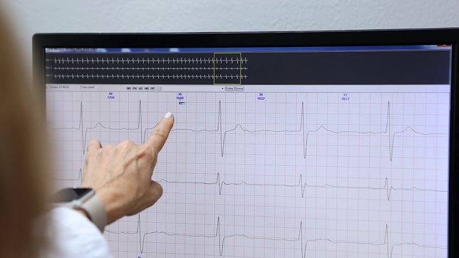 expertos de la unlp buscan mejorar los marcapasos implantables