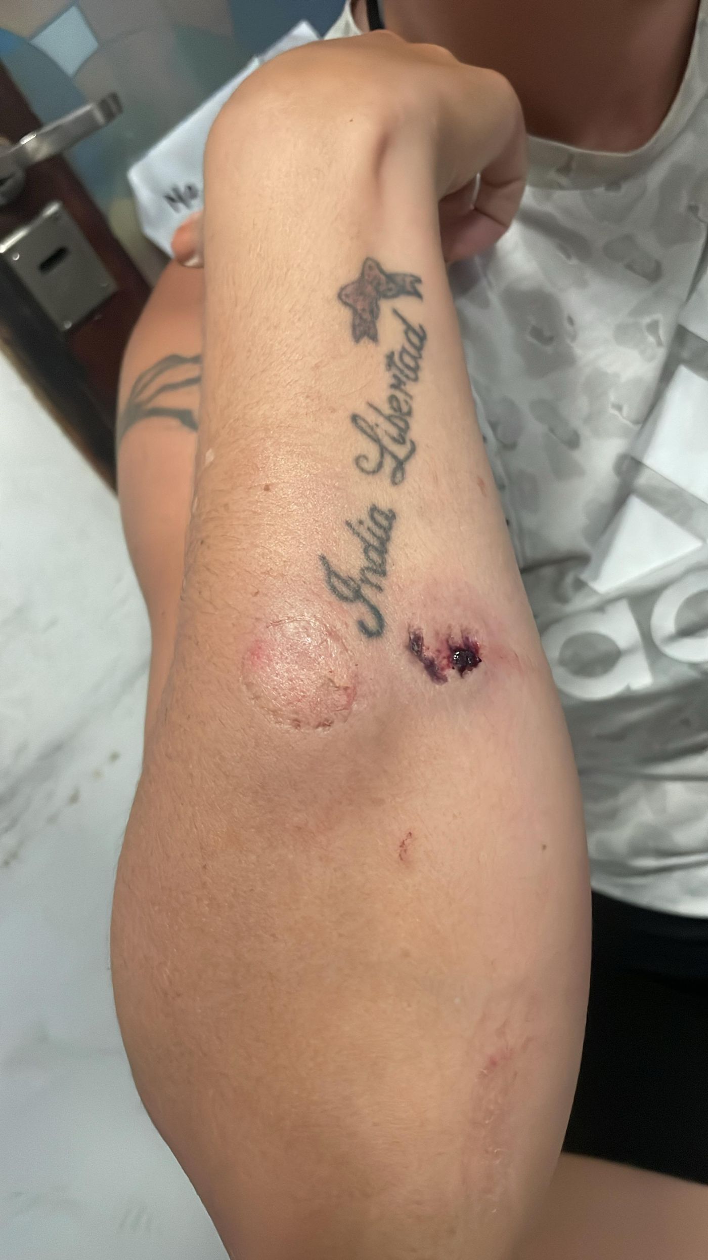 Dos de las m&uacute;ltiples lesiones que recibi&oacute; la mujer en Ensenada