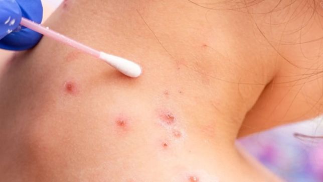 confirmaron el sexto contagio de viruela del mono en argentina