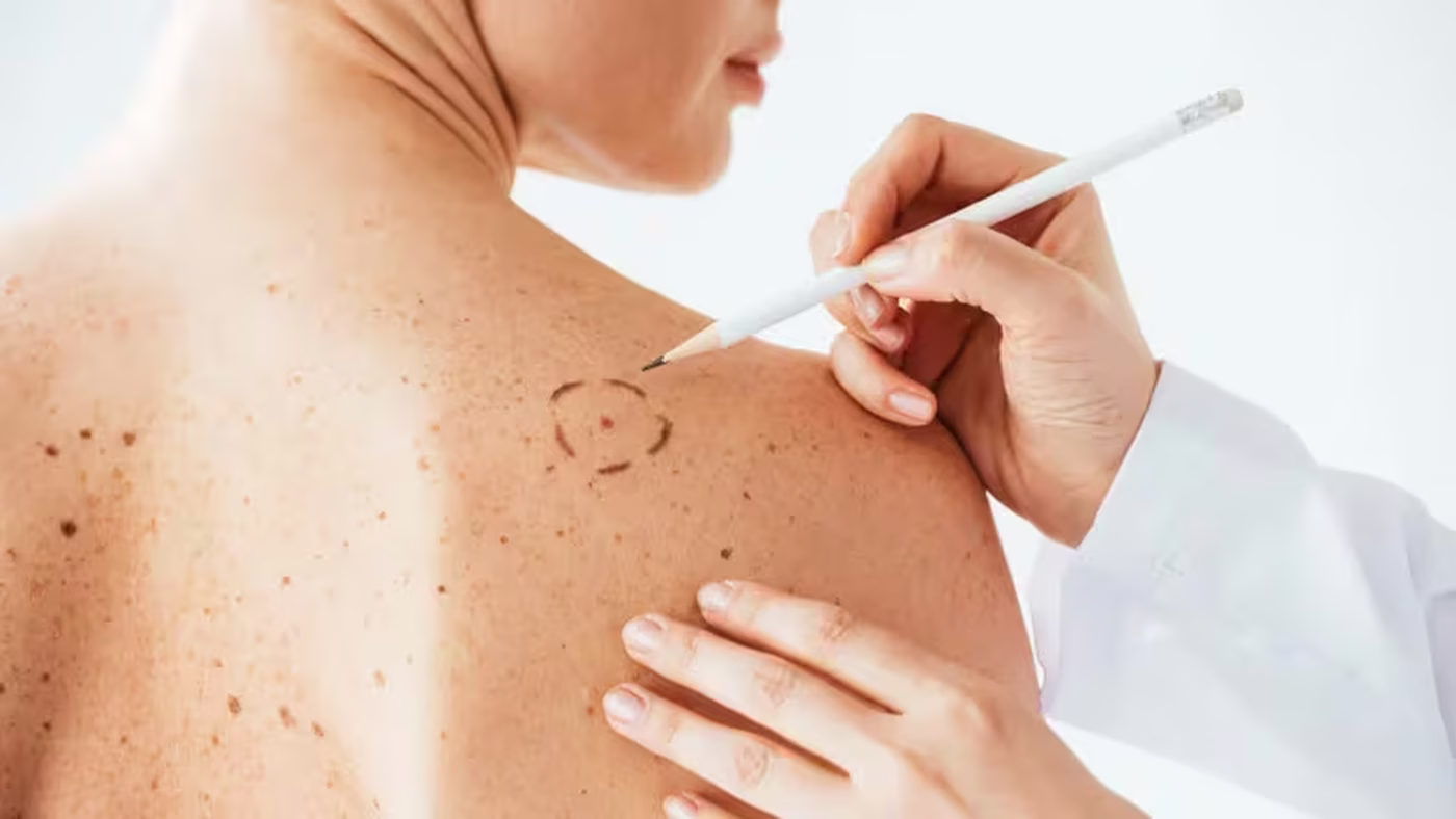 cáncer de piel 1.avif