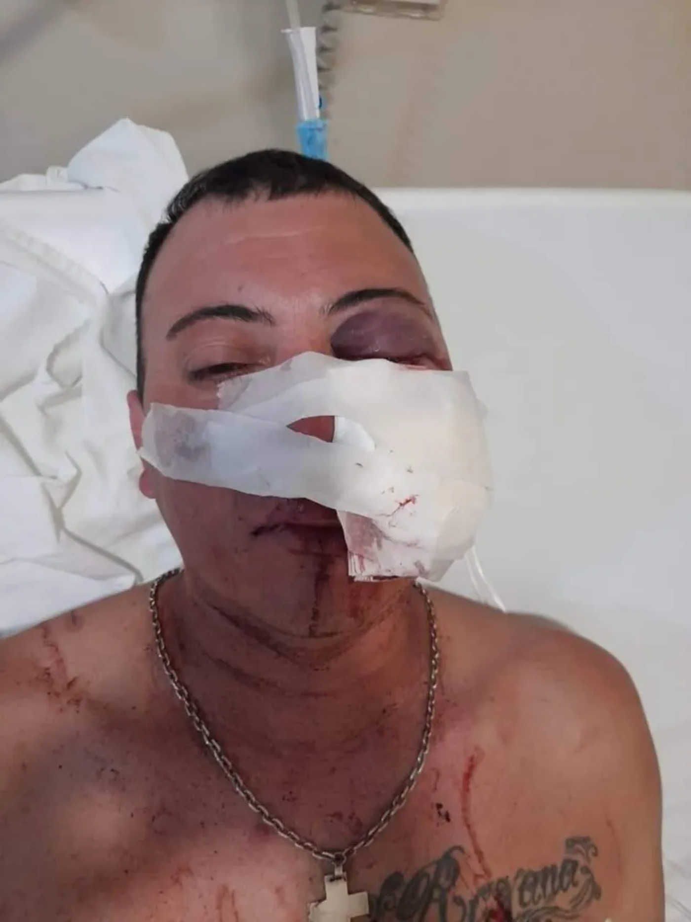 Rodrigo Arballo, el hincha de Gimnasia que perdió un ojo durante la salvaje represión policial.