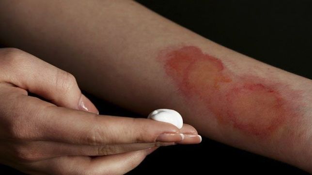 que hacer y que no frente a los accidentes mas frecuentes durante las vacaciones