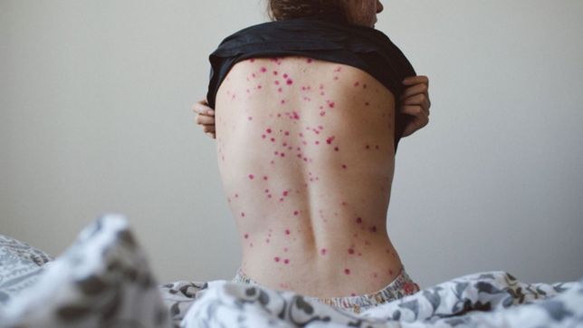 confirman un total de 396 casos de viruela del mono en argentina