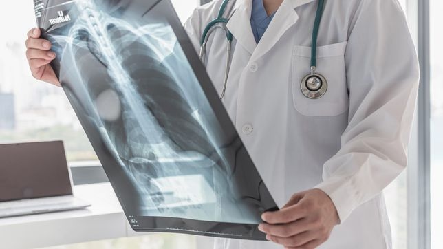 aumentaron los casos de tuberculosis en argentina y advierten sobre los riesgos de la baja vacunacion