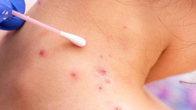 viruela del mono: 10 preguntas para entender que es, de que se trata y como actuar