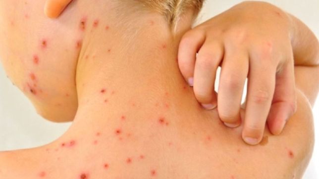 tras casi un ano, en la provincia de buenos aires ya no hay mas brote de sarampion